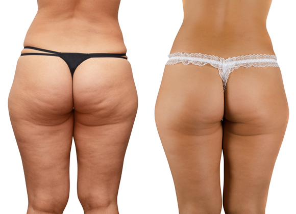 Méregtelenítés Infraslim X technológiával